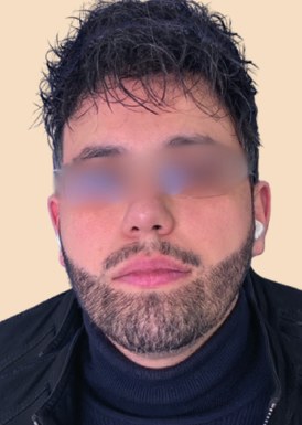Greffe capillaire FUE de 2 100 greffons, ligne frontale – après