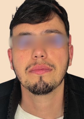 Greffe capillaire FUE de 2 100 greffons, ligne frontale – avant