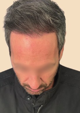 Greffe capillaire FUE de 3 300 greffons, golfes et sommet – après